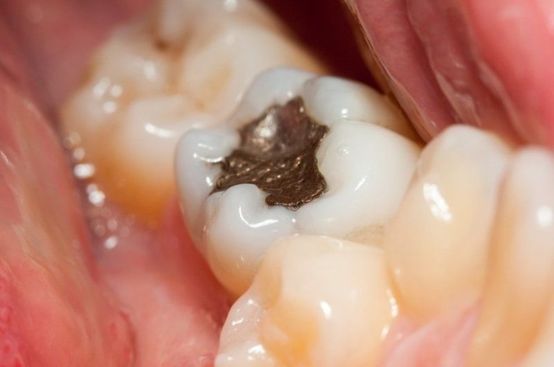 The Dangers Of Amalgam Fillings: Why You Don’t Want This In Your Mouth