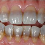 Tooth Discoloration