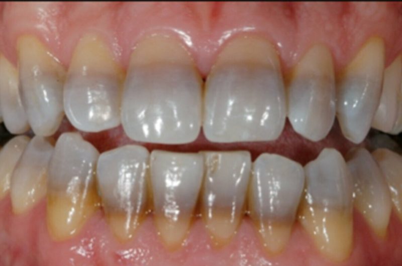 Tooth Discoloration: Causes And Best Solutions