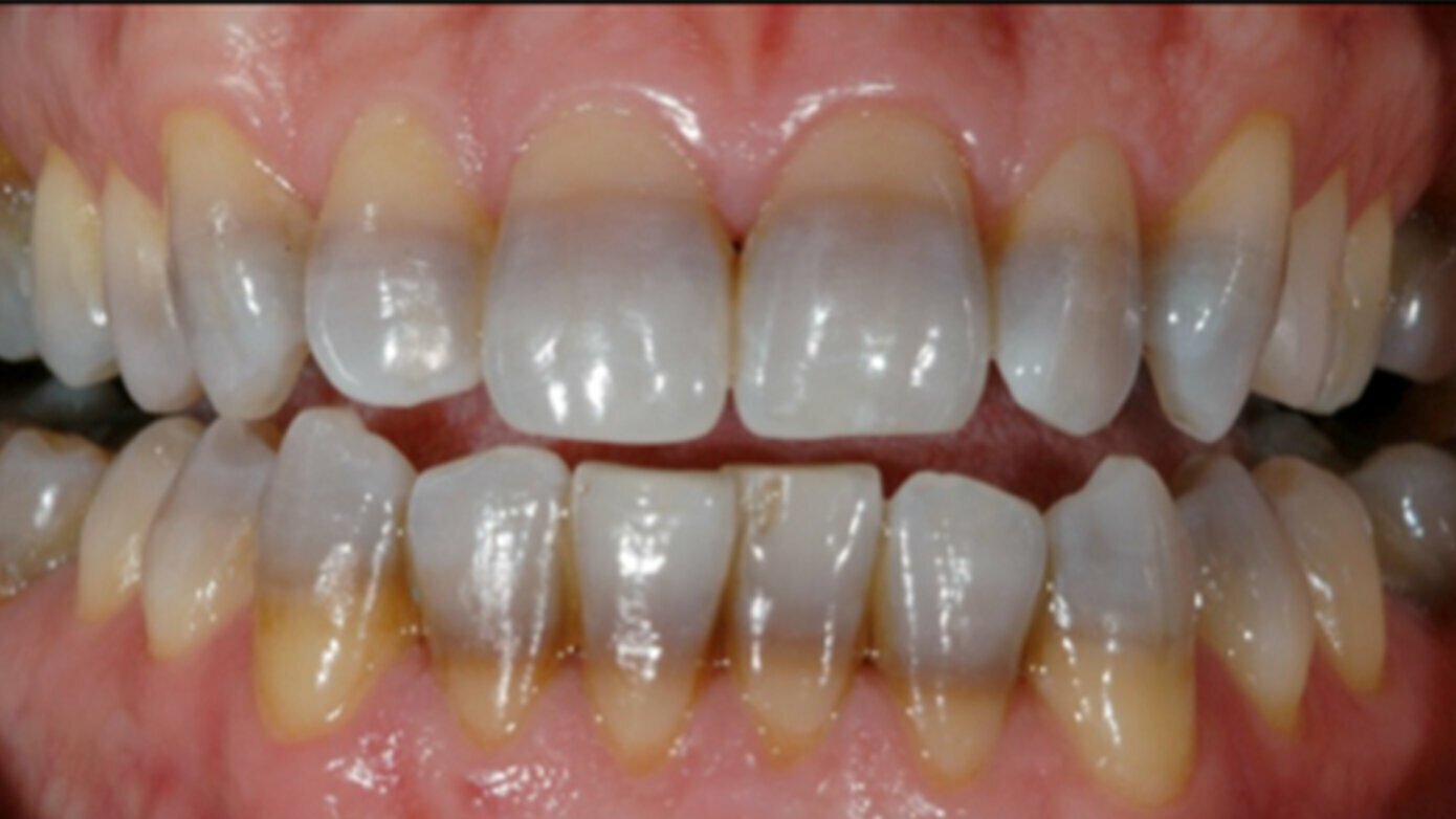 Tooth Discoloration: Causes And Best Solutions