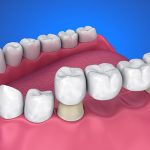 Tooth Replacement Options