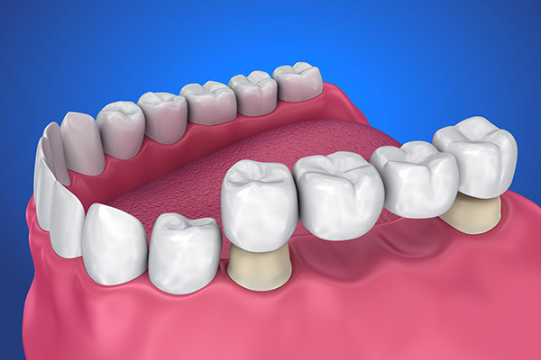 Tooth Replacement Options: Implants, Bridges, Dentures