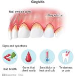 Treatment Of Gum Disease