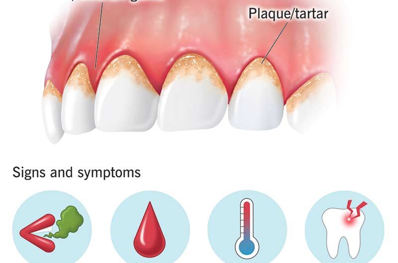 Treatment Of Gum Disease