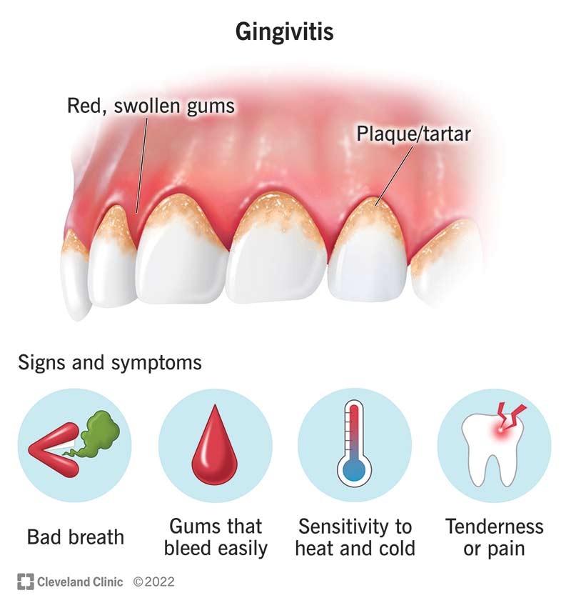 Treatment Of Gum Disease