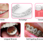 Types Of Braces