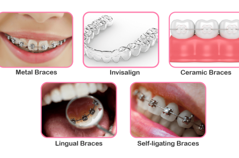 Types Of Braces