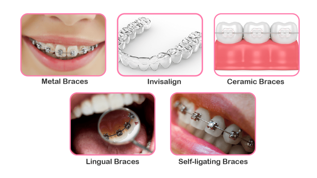 Types Of Braces