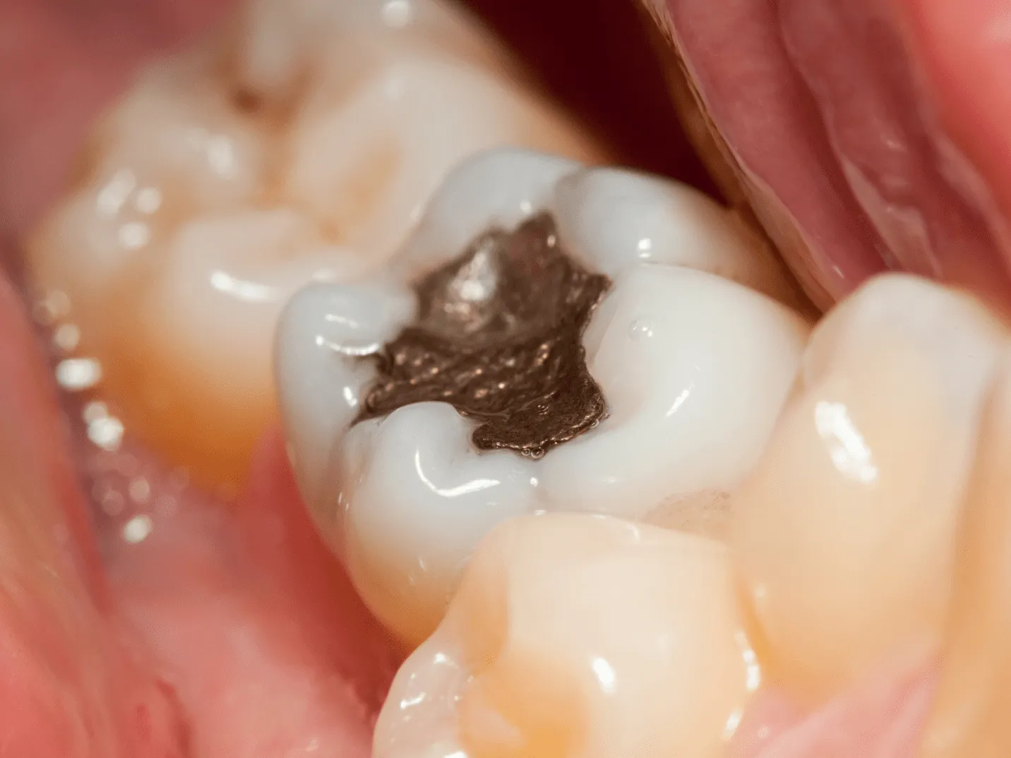 All You Need To Know About Dental Amalgam Safety