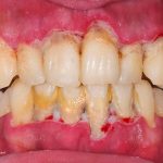 Gum Disease: Symptoms, Causes And Treatments