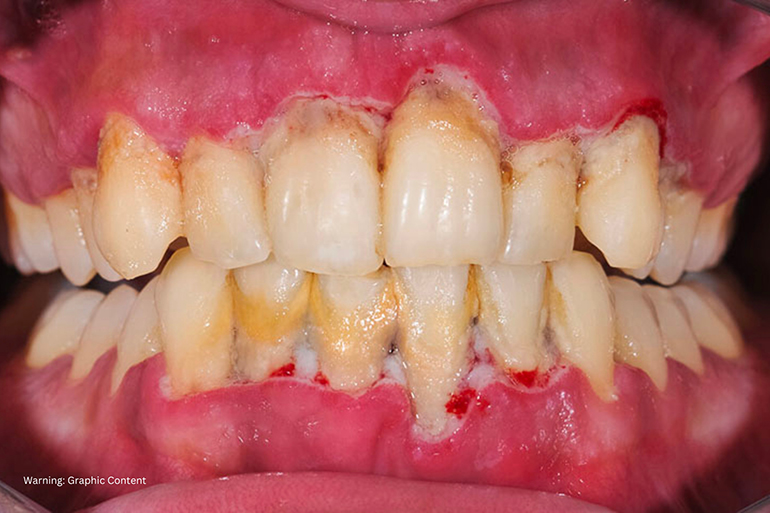 Gum Disease: Symptoms, Causes And Treatments