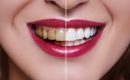 how long does teeth whitening last 2560x1440 1 Serenity International Dental Clinic Vietnam