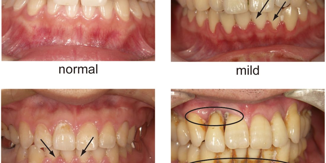 periodontal diseases