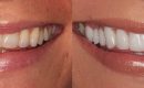 smile makeover Serenity International Dental Clinic Vietnam
