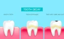 stages of tooth decay Serenity International Dental Clinic Vietnam