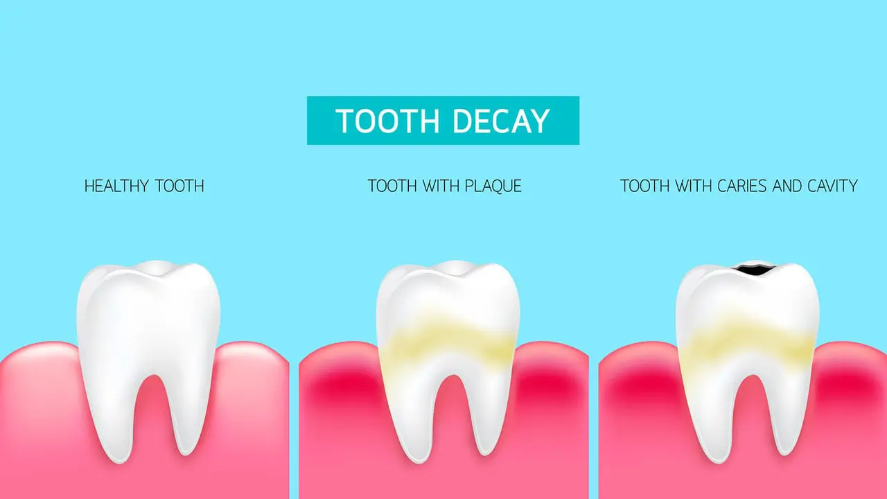 stages of tooth decay Serenity International Dental Clinic Vietnam