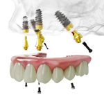 All-on-4 vs Traditional Implants