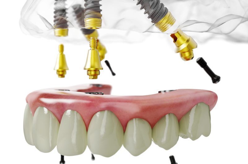 All-on-4 vs Traditional Implants: Which Is Right for You?